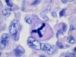TripolarMitosis-breastcarcinoma.jpg