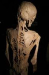 Fibrodysplasiaossificansprogressiva.jpg