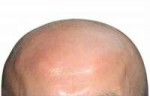cure-baldness-06.jpg