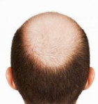 alopetsiya[1].jpeg