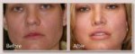 lip-lift-before-after-patient-122 (1).jpg
