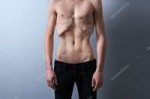 depositphotos113537334-stock-photo-skinny-man-with-anorexia.jpg
