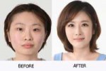 beforeandafterphotosofkoreanplasticsurgerypart264061.jpg