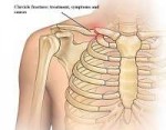 Clavicle-fracture.jpg