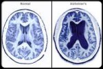 alzheimers-s6-alzheimer-brain-scans.jpg