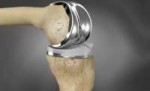 ConforMIS-iTotal-Knee-Implant-620x380-zc-ns.jpg