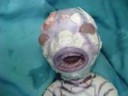Harlequin-Ichthyosis-1.jpg