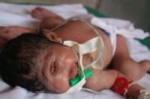 baby-born-with-only-one-eye-lives-just-a-few-days.jpg