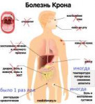 na-chto-vliyaet-bolezn-krona.jpg