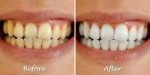 Whiter-teeth-at-home-fast.jpg