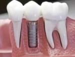 implantanty-zubnye.jpg