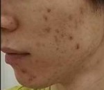 my acne skin.jpg