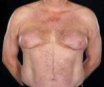 300px-Severebicalutamide-inducedgynecomastia.jpg