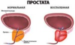 ot-chego-proishodit-prostatita-2.jpg