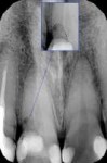 13.06.18 Рентген передних верхниз зубов (с уточнением).jpg