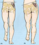 weak-gluteus-medius.jpg