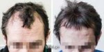 norwood-class-3-hair-transplant-3000-5.jpg