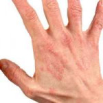 Dermatit-na-rukah.jpg