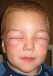 248px-Angioedema2010.JPG