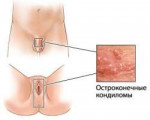 ostrokonechnie-kondilomy-m-z.jpg