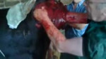пролапс.webm