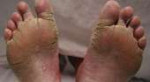 Foot-infections11.jpg