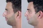 chin-augmentation-04c-male.jpg