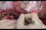 baby autopsy.webm