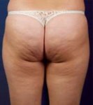 cellulite.jpg