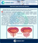 Adenoma-predstatelnoy-zhelezyi.jpg