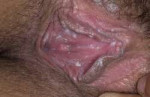 kandidozvaginal-7-a-foto.jpg