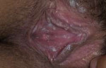 kandidozvaginal-3-a-foto.jpg