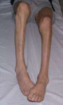 atrophy-leg.jpg