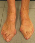 hallux-valgus-1 (1).jpg