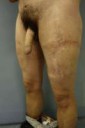 Fig-16-Four-years-postoperative-result-Despite-some-scar-wi[...]