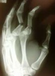 Broken-Finger-Raleigh-Hand