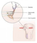 Diagramshowinghowthetesticleisremoved(orchidectomy)CRUK141.[...].png