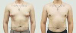 gynecomastia-before-mg-3698-1.e2d48193415983fb5ef519ac793baa56.jpg