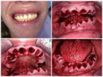 TeethProtesis.jpg