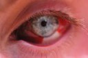 Subconjunctivalhemorrhagestress-57a38c4b3df78cf4593cbafb.JPG