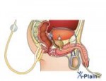 foley-catheter-maleov.jpg