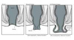 Rectal-Prolapse-Illust-1456x800-1.jpg