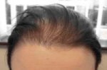 diffuznaya-alopeciya.png