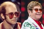 elton-john-hair-transplant-600x400.jpg