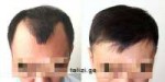 norwood-class-3-hair-transplant-3000-1.jpg