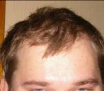 Hairline 2008.png