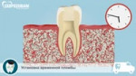 Гранулема зуба  развитие, этапы лечения гранулемы.mp4
