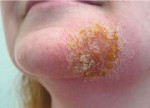 impetigonalice.jpg