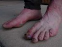 chris-blisters-1.jpg