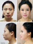 koreianplasticsurgerybeforeafter[1].jpg